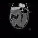 Carcinoma of sigmoid colon, large bowel obstruction, ileus: CT - Computed tomography